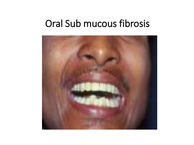 carcinoma buccal mucosa anatomy to management Labial Mucosa Cancer exophytic ulcerative verrucous; 14